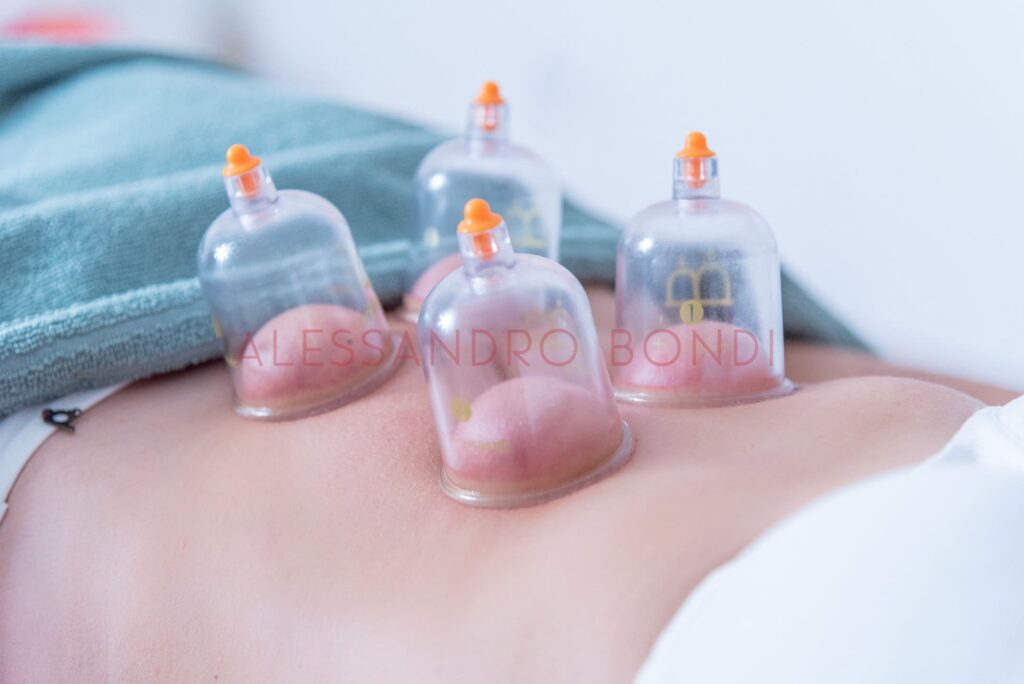 coppettazione addome