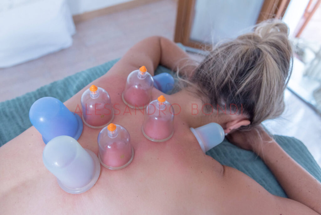 coppettazione schiena